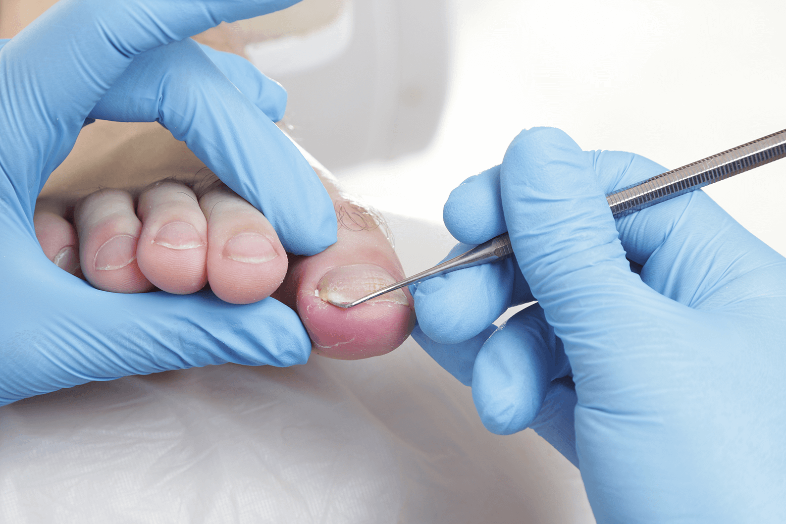 Ingrown Toenail Ingrown Toenail