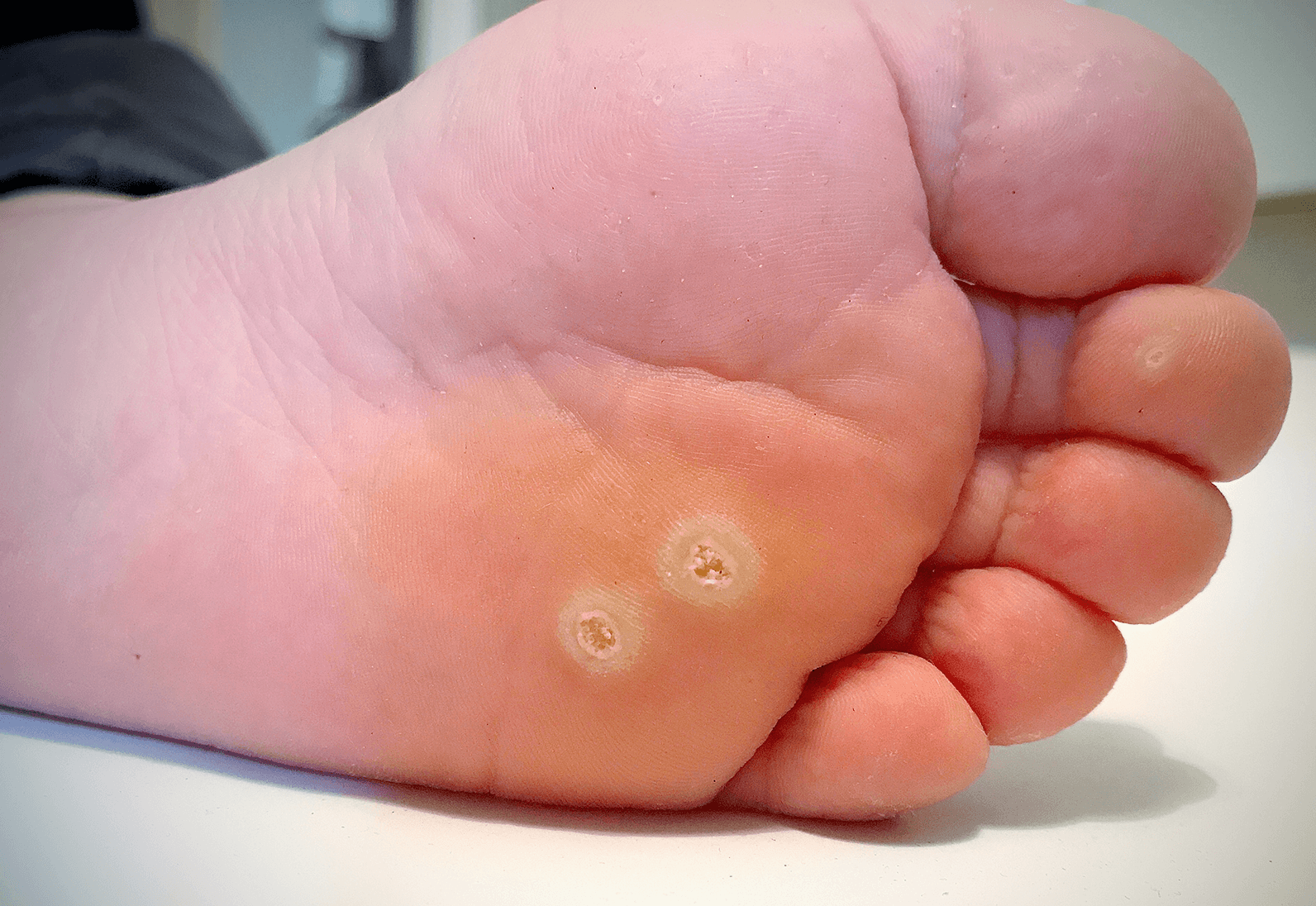 Verrucae - Plantar Wart